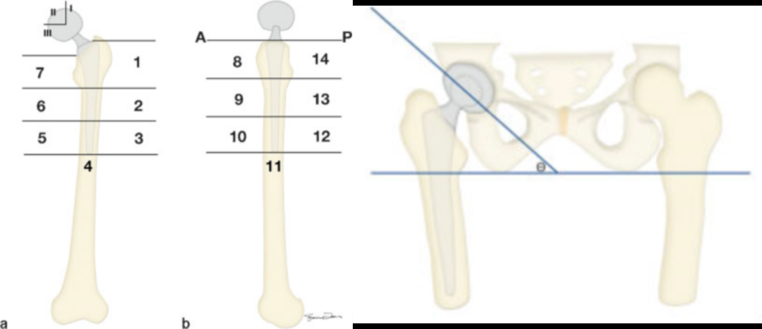 人工髋关节置换术，影像学评估要点看这里！