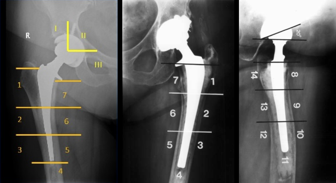 人工髋关节置换术，影像学评估要点看这里！