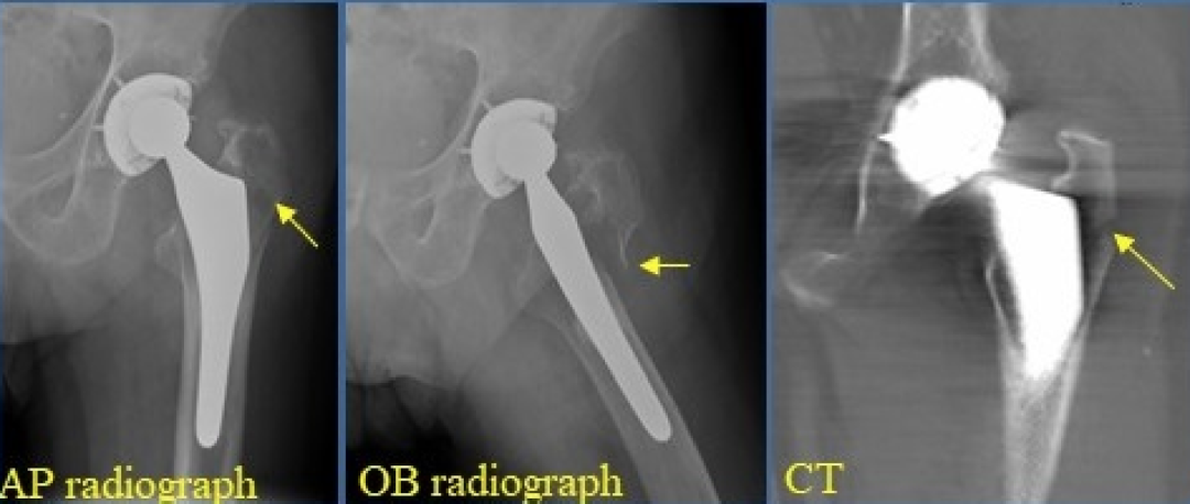 人工髋关节置换术，影像学评估要点看这里！