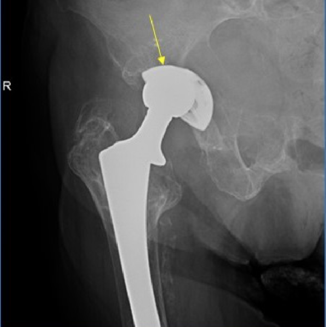 人工髋关节置换术，影像学评估要点看这里！