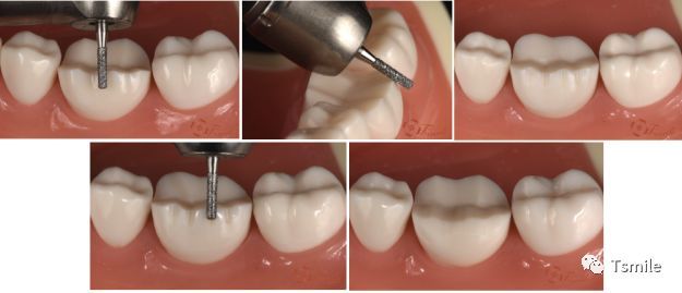 一步一步做好后牙全瓷冠牙体预备