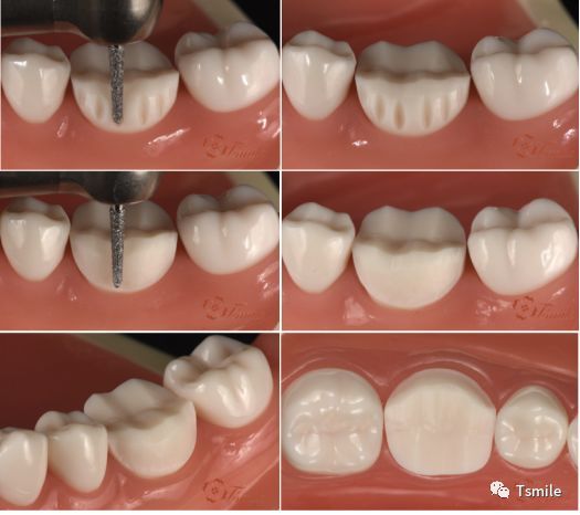一步一步做好后牙全瓷冠牙体预备