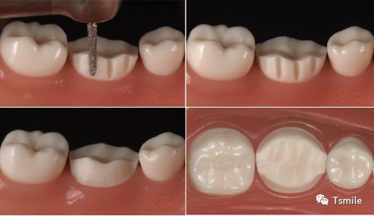 一步一步做好后牙全瓷冠牙体预备