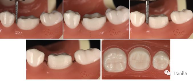 一步一步做好后牙全瓷冠牙体预备