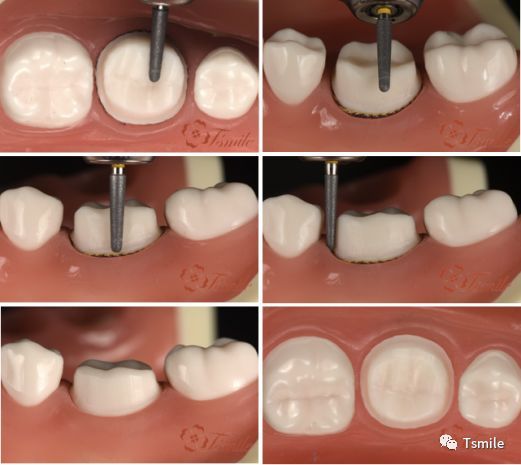 一步一步做好后牙全瓷冠牙体预备
