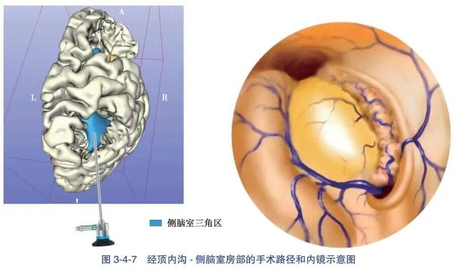 经顶内沟- 侧脑室三角区入路血肿清除术-人卫书摘