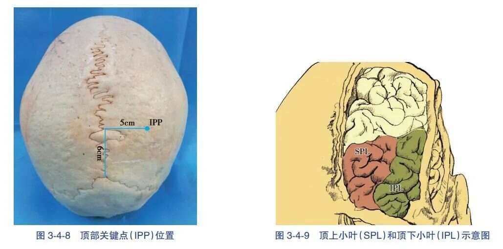 经顶内沟- 侧脑室三角区入路血肿清除术-人卫书摘