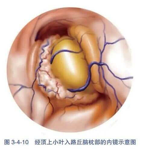 经顶内沟- 侧脑室三角区入路血肿清除术-人卫书摘