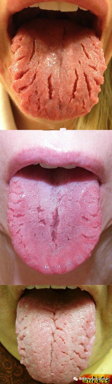 裂纹舌的中医治疗