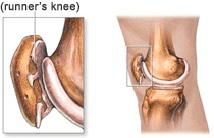 破除跑步伤膝的魔咒--认识跑者膝