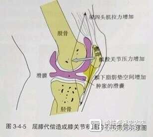 平衡疼痛---- 膝调节代偿与症状