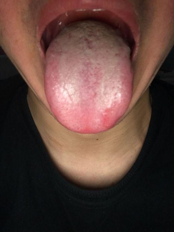 珍贵舌诊：阴精不足、脾肾阳虚、心肺火旺的舌苔，看完记得存！