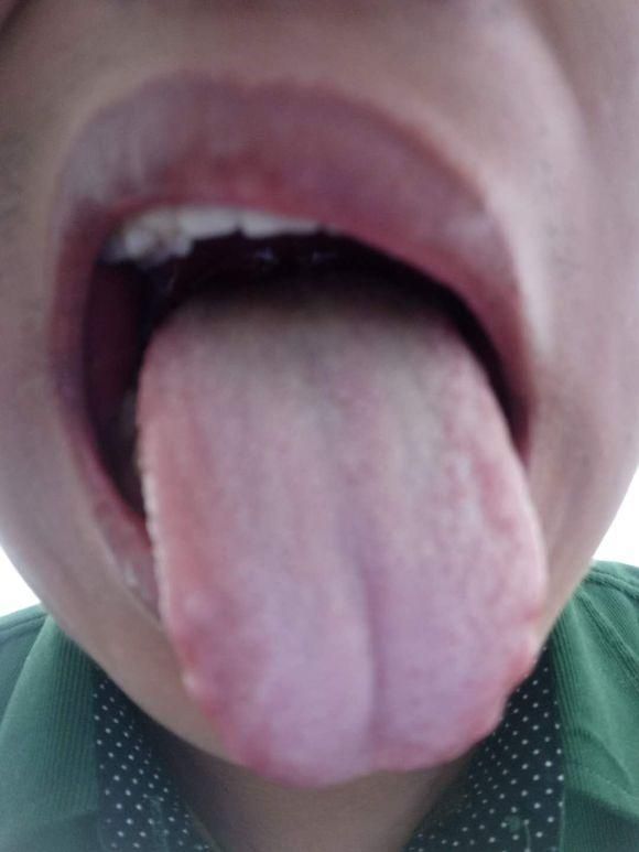 珍贵舌诊：阴精不足、脾肾阳虚、心肺火旺的舌苔，看完记得存！