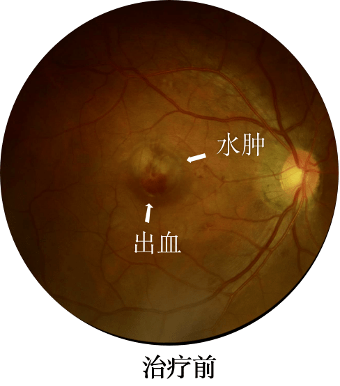 倪海厦针灸笔记（三八七）治眼证及睛中法