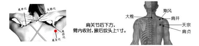 中医传统保健穴位养生——针灸艾灸治疗坐骨神经痛、腰椎间盘突出...