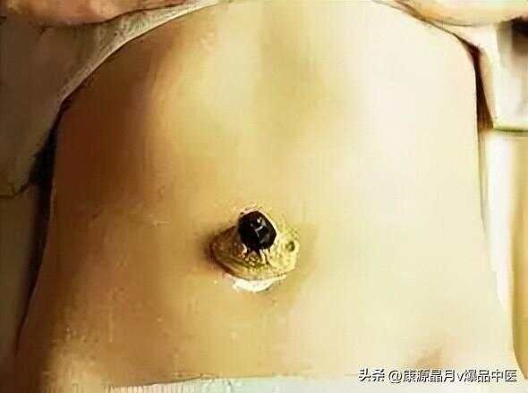 分享民间50种病的肚脐疗法