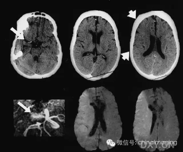 图文详解缺血性脑卒中早期CT表现