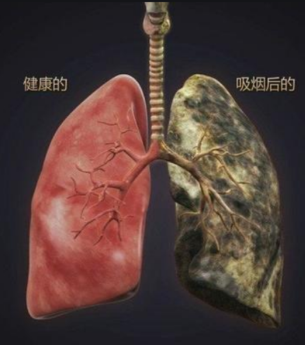 《金匮悬解》——肺痈、肺痿、咳嗽上气