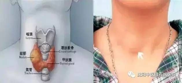 体检查出这9种病，千万别自己吓自己 !