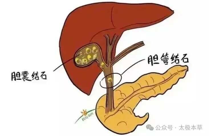 神奇两剂方，和胆结石彻底说“拜拜”