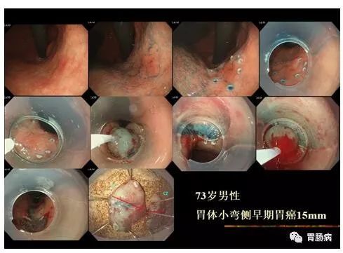 内镜粘膜下剥离术（ESD）