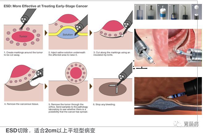 内镜粘膜下剥离术（ESD）