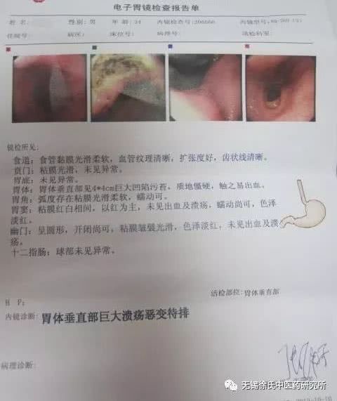 中医治胃病，莫等变胃癌