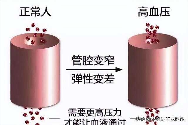 高血压一辈子离不开降压药老中医揭秘 部分高血压可调可控可逆转