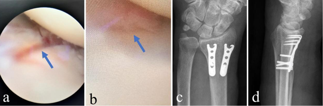 交大一附院实施世界首例腕关节镜辅助微创桡骨远端骨折内固定术