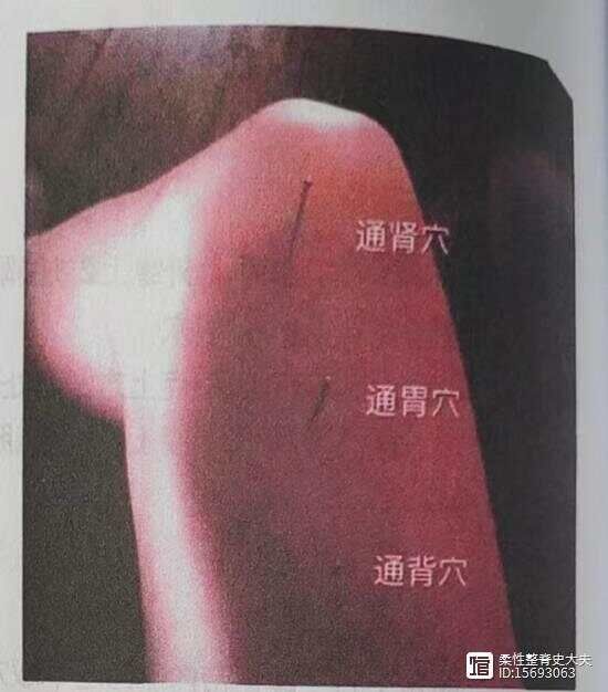 临床特效三针（五）
