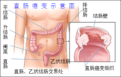直肠癌治疗“特效穴”