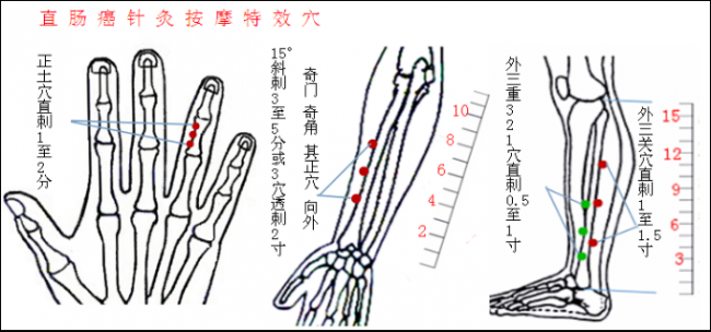 直肠癌治疗“特效穴”