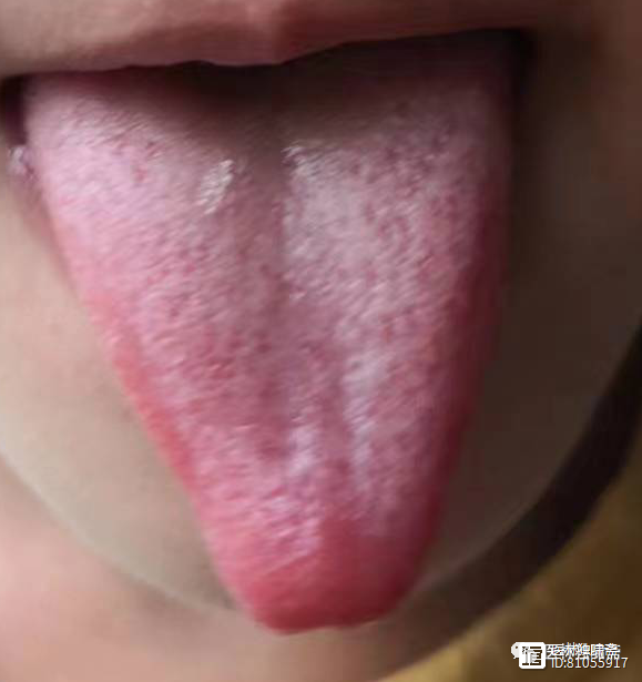 小女孩流感高烧39℃几经误治，柴胡五根汤一剂热退人安