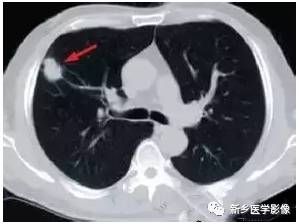 肺磨玻璃密度结节处理，牢记这六点！