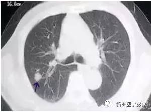 肺磨玻璃密度结节处理，牢记这六点！
