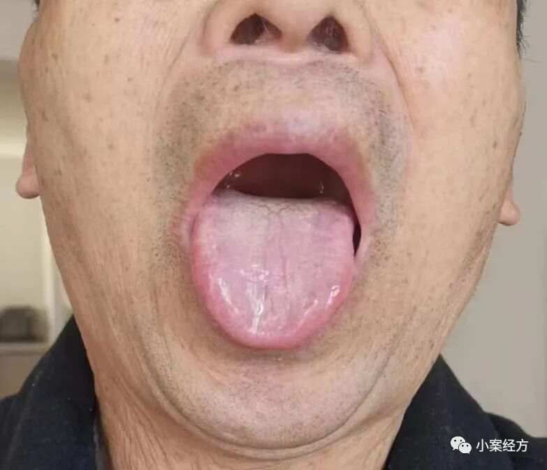 第228案：升麻鳖甲汤合桂枝茯苓丸治前列腺癌骨转移案
