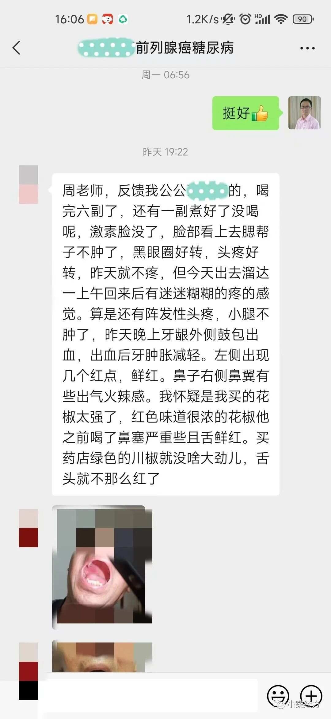 第228案：升麻鳖甲汤合桂枝茯苓丸治前列腺癌骨转移案