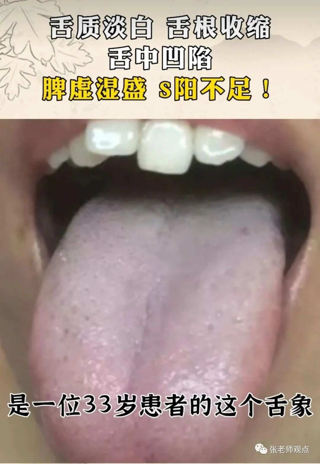 学习看舌相（一）