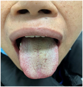 张宏丰用经方乌梅丸与大温脾丸变方治“久利、久咳”