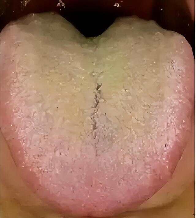 百病皆因痰，抑郁先除痰，一个厉害中成药，化痰祛湿，巧治抑郁症