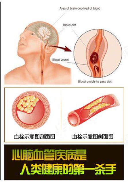 名医秘方将血管壁清理干净的效方，根治心脑血管病