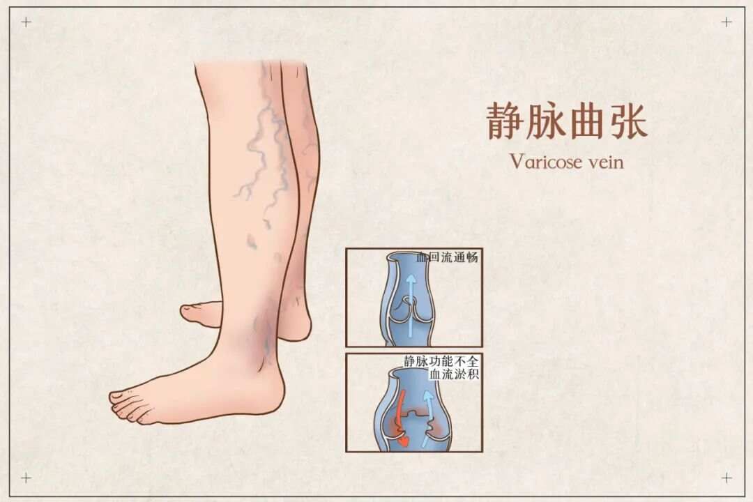 张锡纯静脉曲张名方，化掉瘀血，打通经络