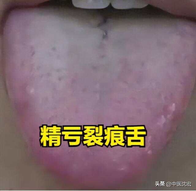 精虚裂纹舌用五子衍宗，气血虚裂纹舌用四物，阳虚裂纹舌用真武汤