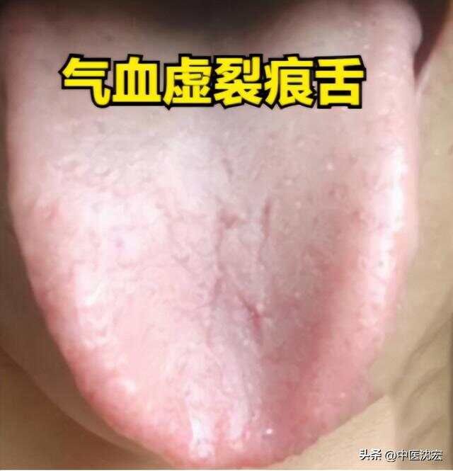 精虚裂纹舌用五子衍宗，气血虚裂纹舌用四物，阳虚裂纹舌用真武汤