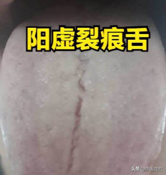 精虚裂纹舌用五子衍宗，气血虚裂纹舌用四物，阳虚裂纹舌用真武汤