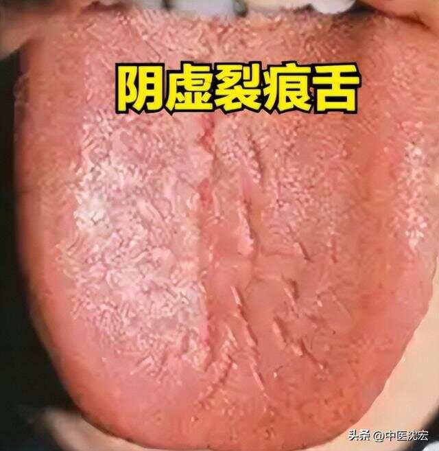 精虚裂纹舌用五子衍宗，气血虚裂纹舌用四物，阳虚裂纹舌用真武汤