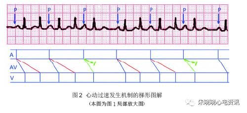 郭继鸿教授心电系列之三双房室结非折返性心动过速