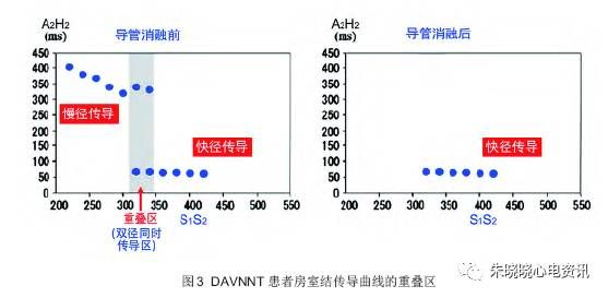 郭继鸿教授心电系列之三双房室结非折返性心动过速
