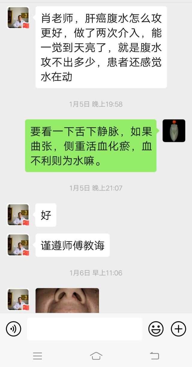 中医有四大顽疾：风，劳，臌，膈*肝腹水(肖春宏老师)
