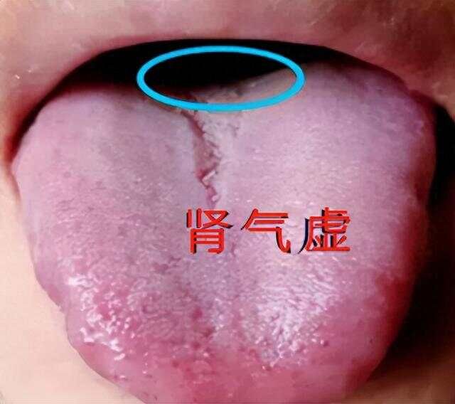 临床诊断基础:裂纹舌怎么调